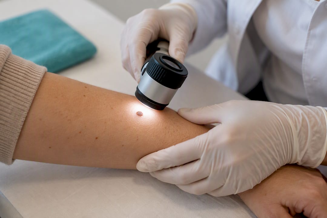 Dermatologul inspectează o aluniță cu dermatoscopul